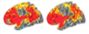 Adult and childs brains diplaying where cortex areas where folding was linked to intelligence.