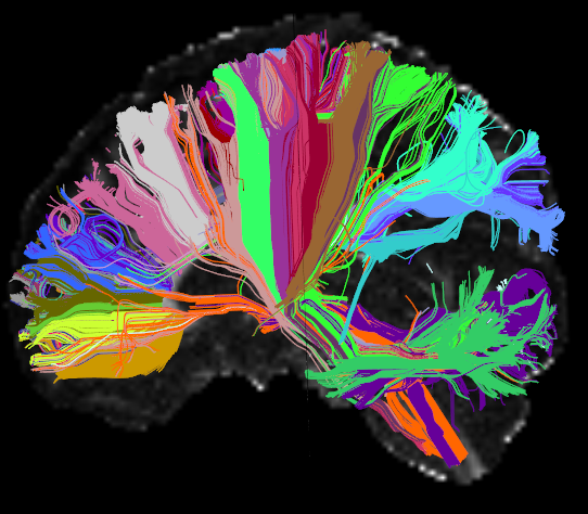 High Angular Resolution Diffusion Image (HARDI) of the human brain