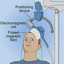 Illustration of repetitive transcranial magnetic stimulation