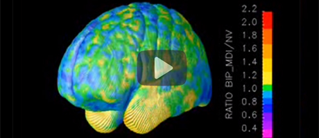 animated video of MRI scan showing brain development in bipolar youth