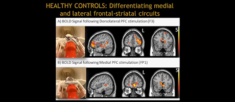 NIH Multimodal Brain Stimulation Speaker Series - Colleen Hanlon